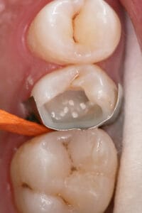 Dentapreg® PINPost application with a matrix for composite filling support.