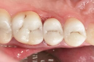 Final restoration with Dentapreg® PINPost for a natural tooth appearance.