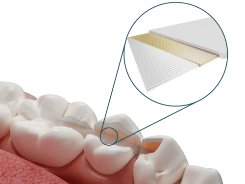 Dentapreg® SFU Splinting & Reinforcement