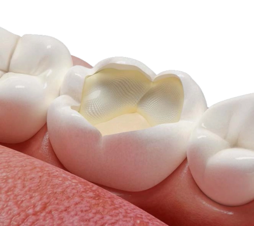 Fibrafill® CUBE che rinforza una cavità molare per il restauro.