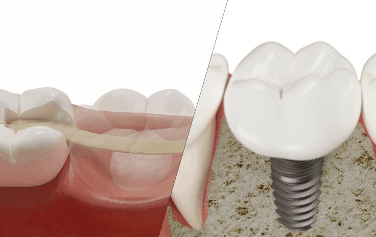 Dental Bridge vs Implant: Which is Right for You?